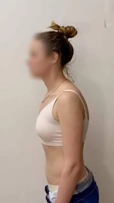 Client before postural massage treatment, showing initial standing posture