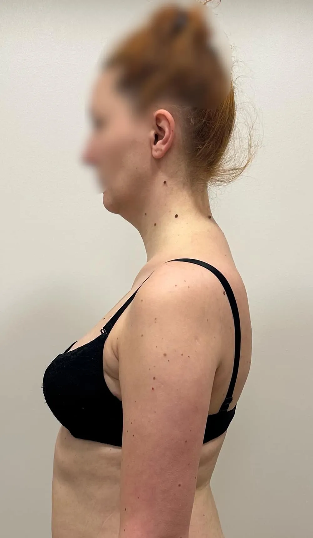 Client before postural massage treatment, showing initial standing posture